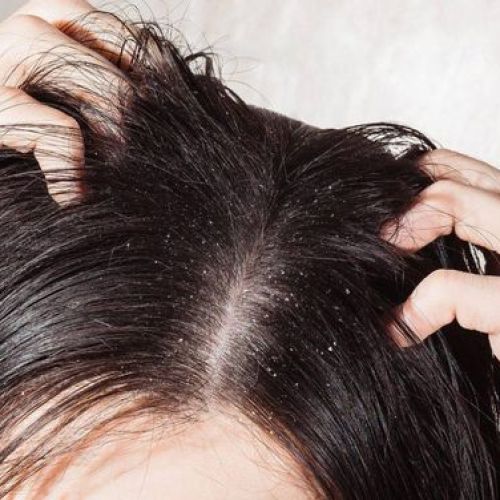 How to Treat Dandruff at Home with Safe & Effective Natural Ingredients