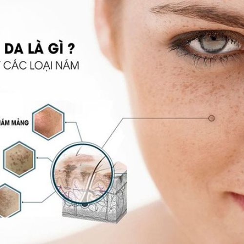 Nám da là gì? Nguyên nhân hình thành, phân biệt các loại nám