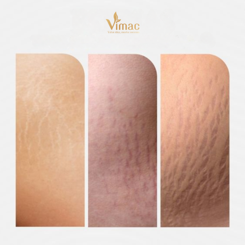 HOW TO TREAT POST-PARTUM STRETCH MARKS AT HOME