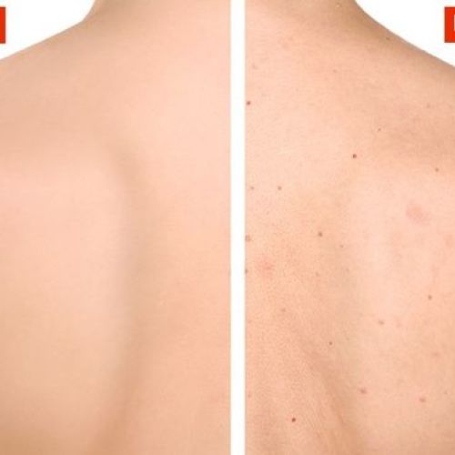 HOW TO EFFECTIVELY TREAT BACK ACNE AT HOME