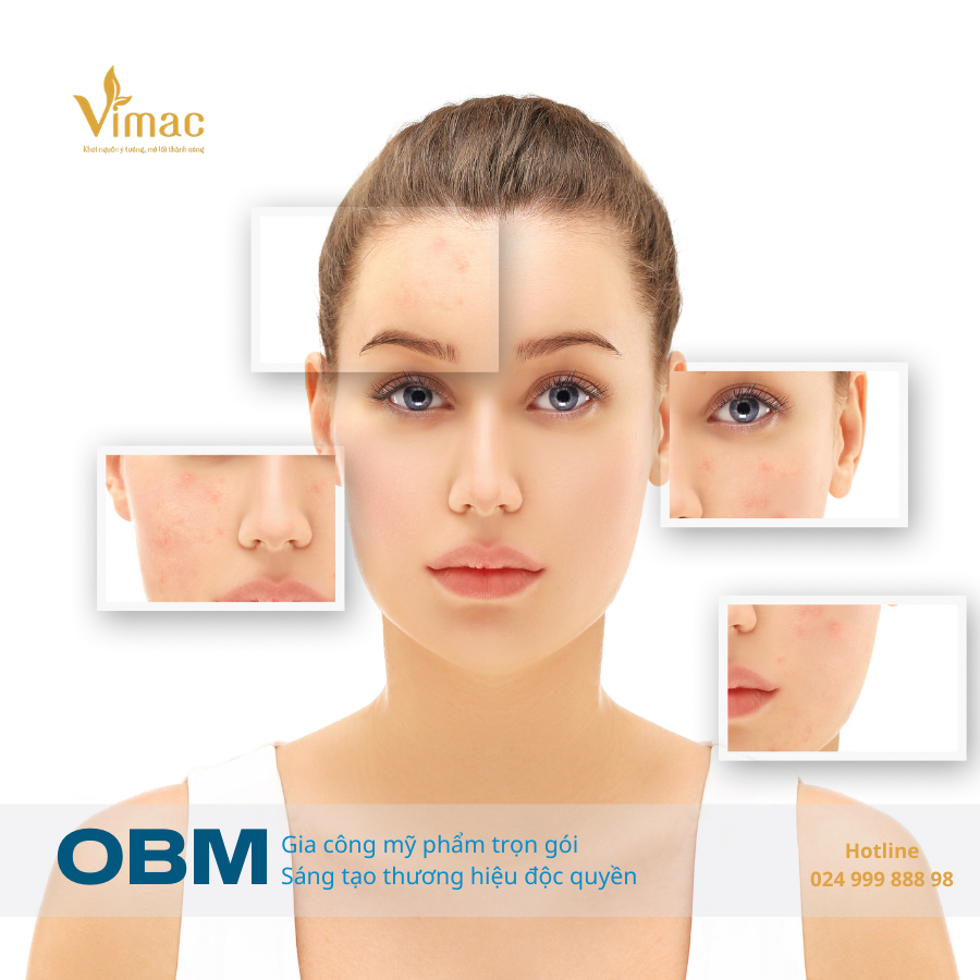 GIa công kem trị mụn 2