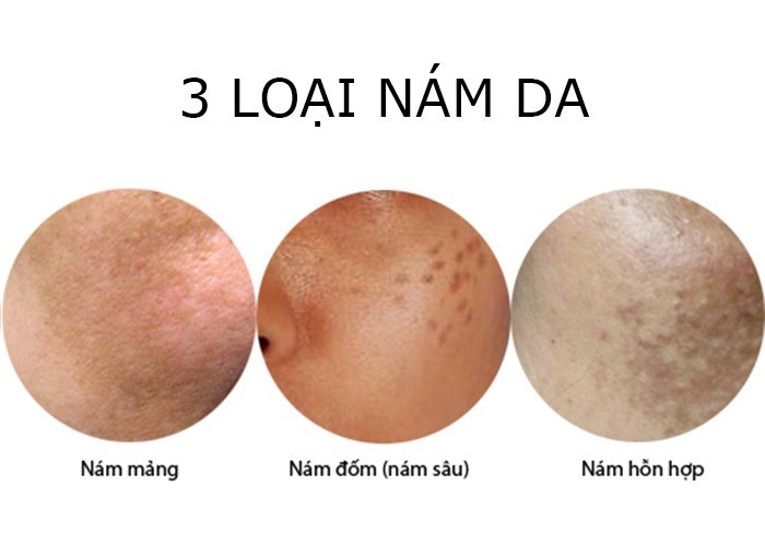 Nam-da-la-gi-Cach-tri-nam-da-Vimaccos (4)