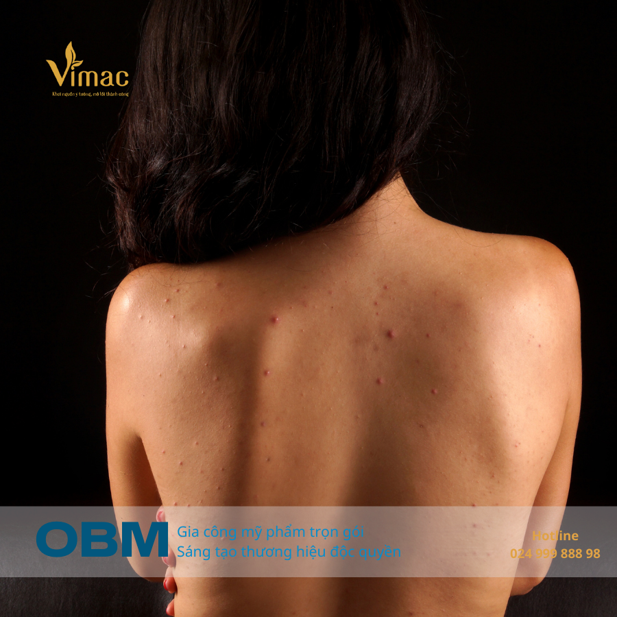sữa tắm trị mụn lưng 1