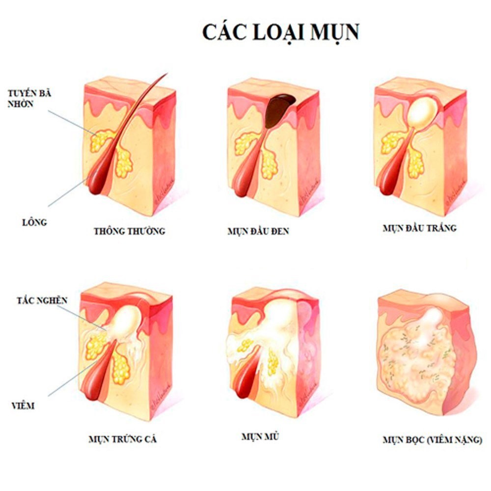 sữa tắm trị mụn lưng 5